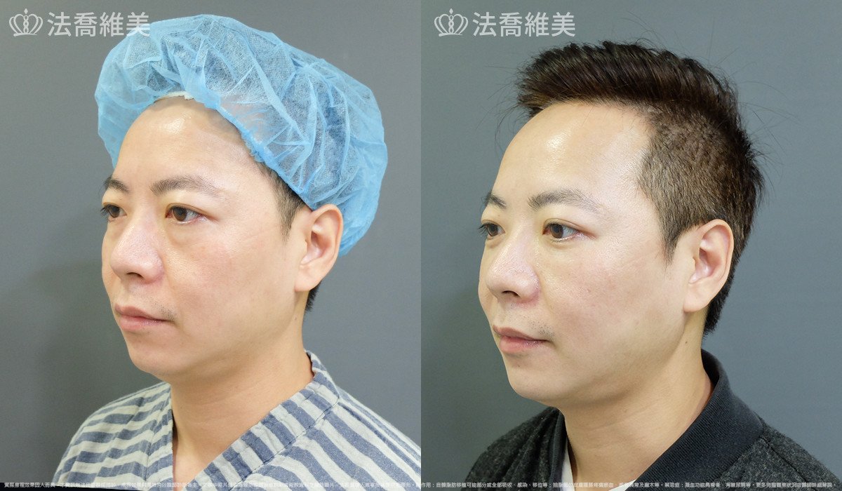 法喬醫美診所,邱浚彥,自體脂肪補蘋果肌及法令