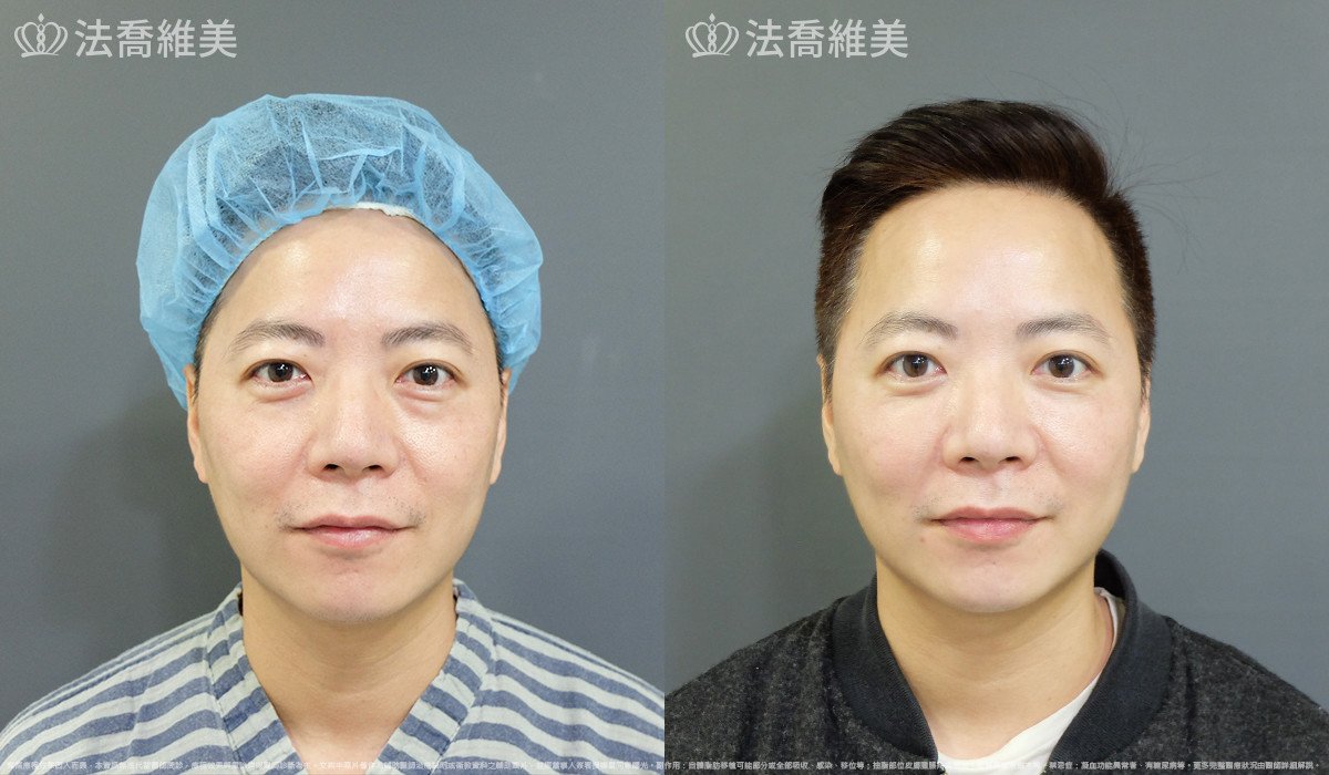 法喬醫美診所,邱浚彥,自體脂肪補蘋果肌及法令