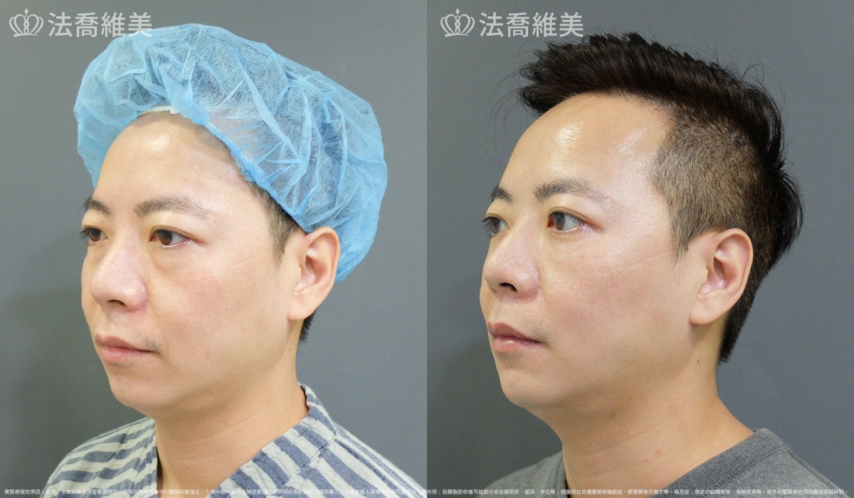 法喬醫美診所,邱浚彥,自體脂肪補蘋果肌及法令