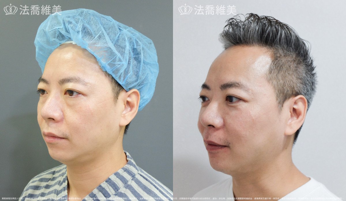法喬醫美診所,邱浚彥,自體脂肪補蘋果肌及法令