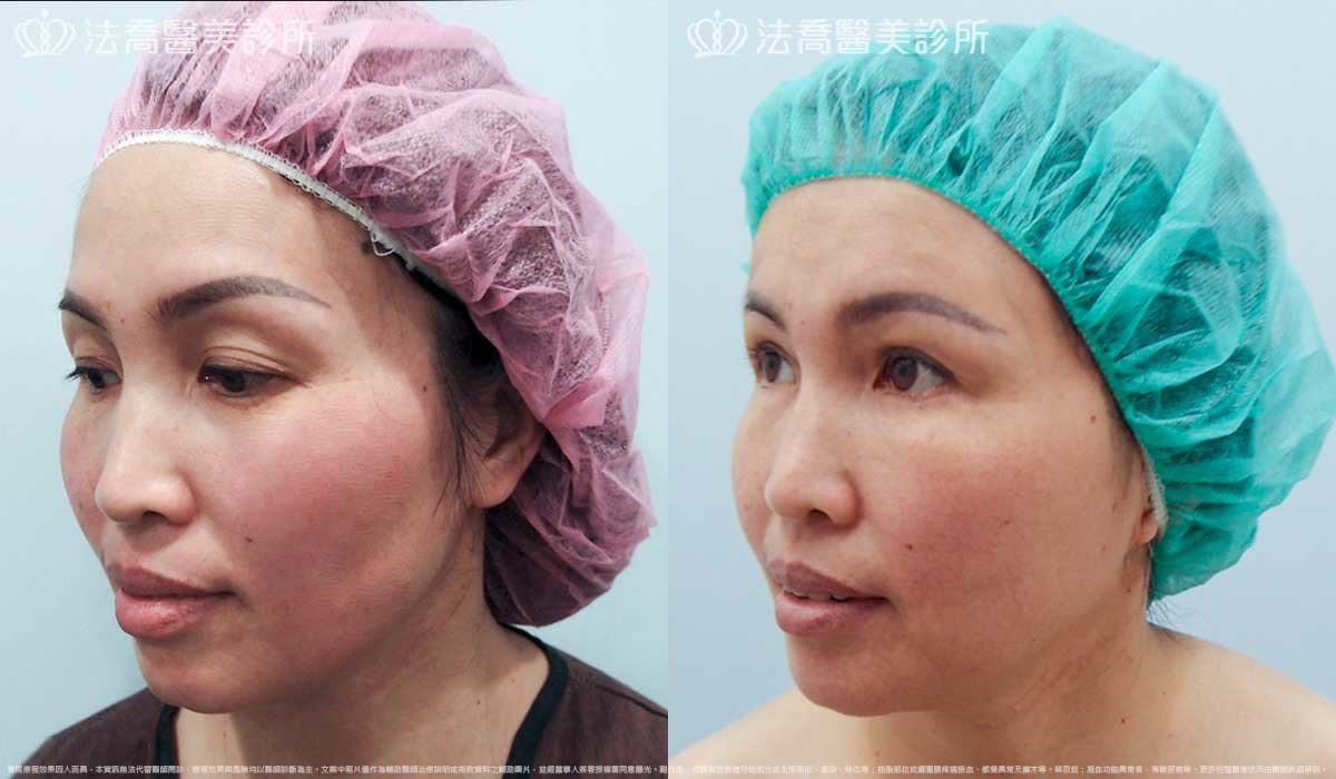 法喬醫美診所,邱浚彥,自體脂肪豐臉,割雙眼皮,眼袋外開