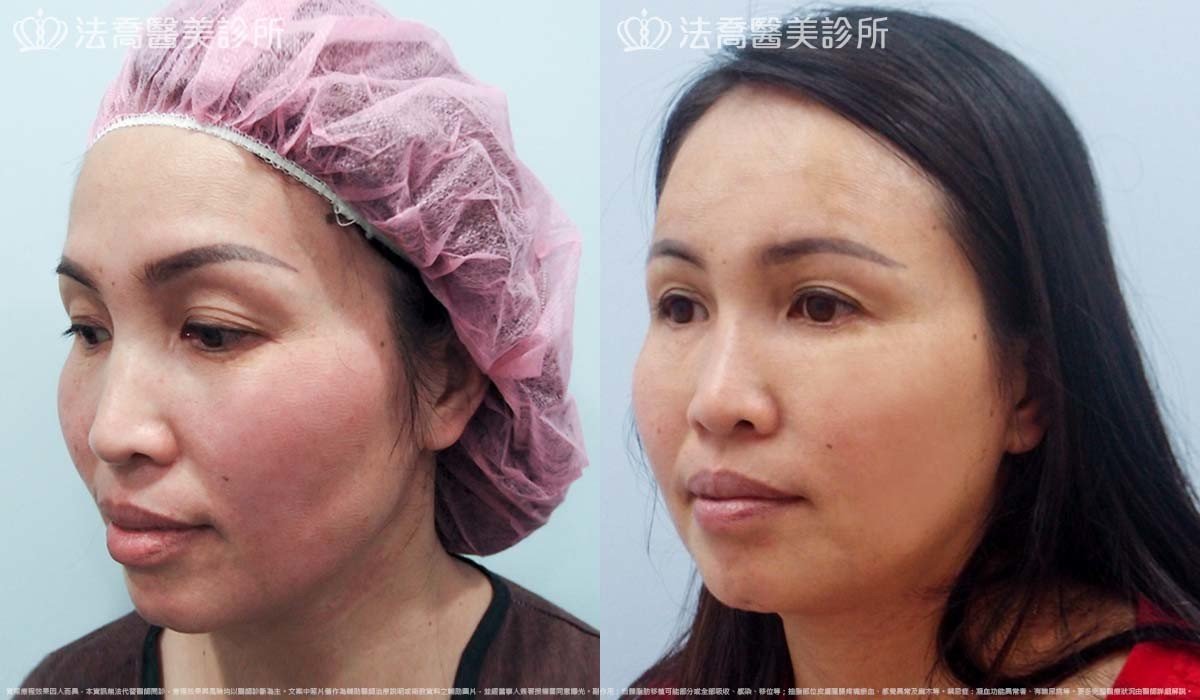 法喬醫美診所,邱浚彥,自體脂肪豐臉,割雙眼皮,眼袋外開
