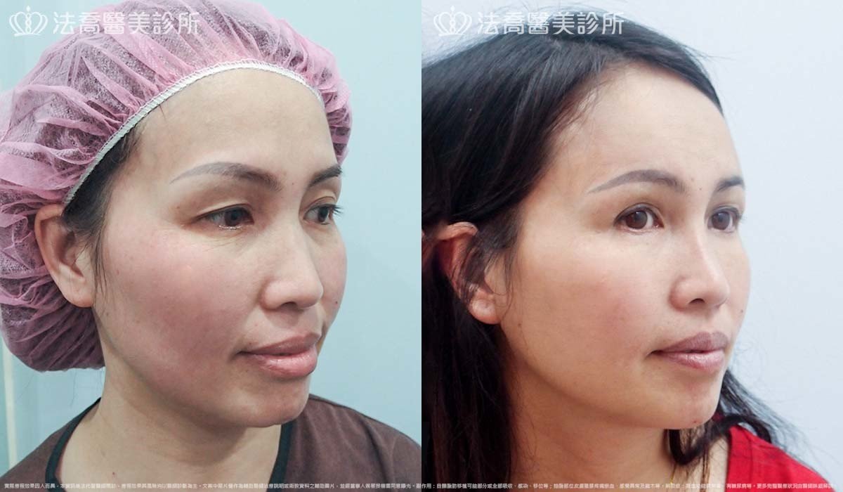 法喬醫美診所,邱浚彥,自體脂肪豐臉,割雙眼皮,眼袋外開