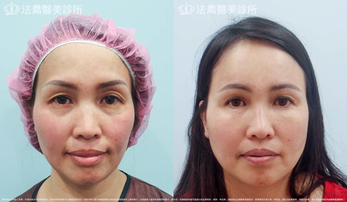 法喬醫美診所,邱浚彥,自體脂肪豐臉,割雙眼皮,眼袋外開