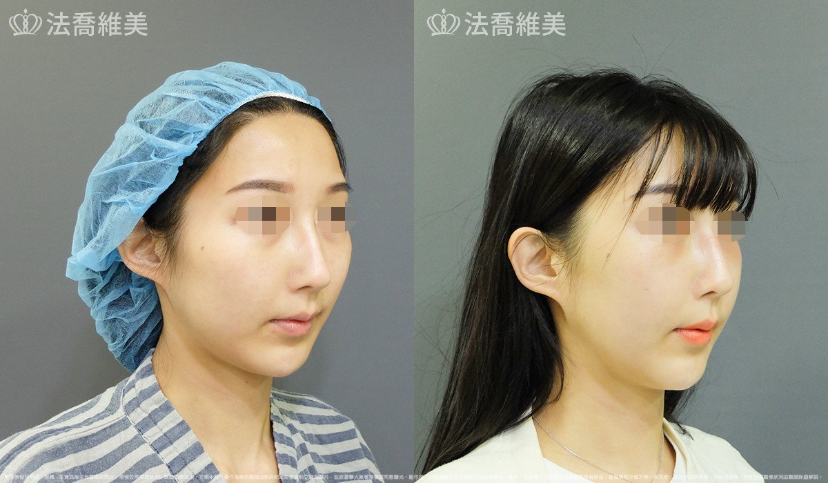 法喬醫美診所,邱浚彥,自體豐全臉