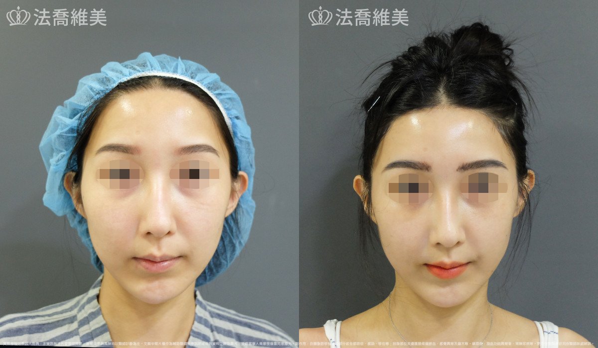 法喬醫美診所,邱浚彥,自體豐全臉