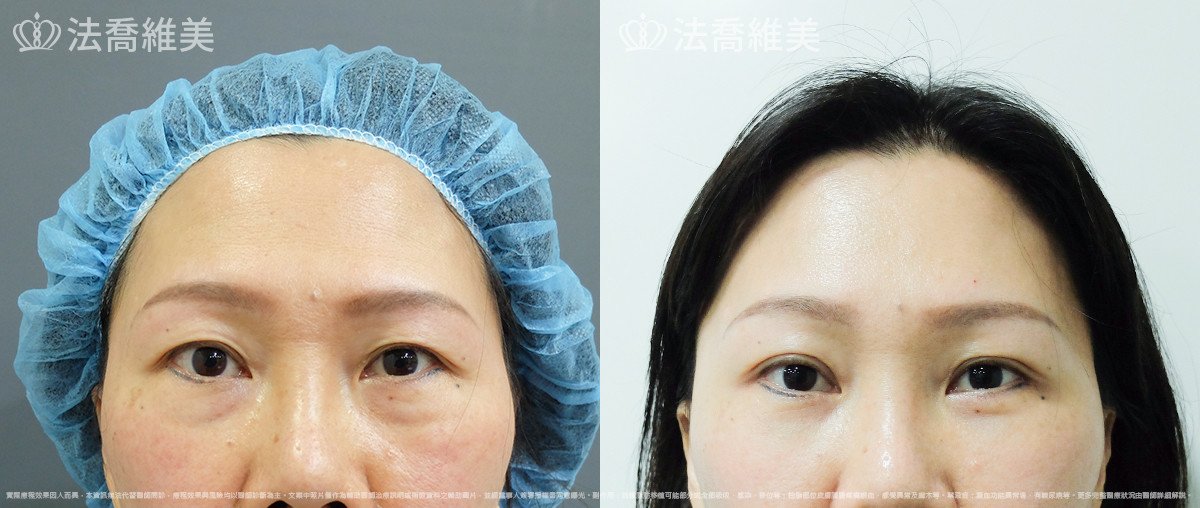 法喬醫美診所,邱浚彥,自體脂肪豐蘋果肌