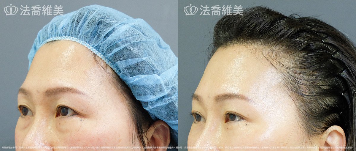 法喬醫美診所,邱浚彥,自體脂肪豐蘋果肌