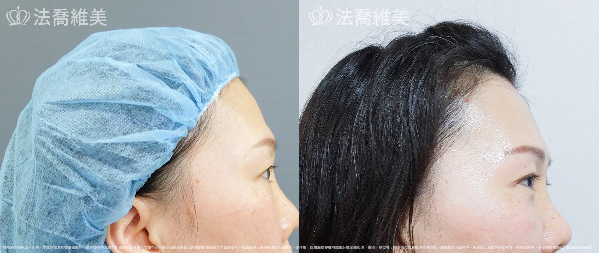 法喬醫美診所,邱浚彥,自體脂肪豐蘋果肌