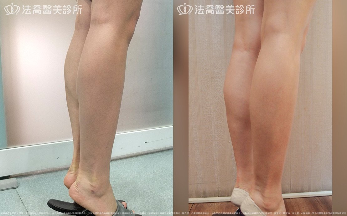 法喬醫美診所,邱浚彥,小腿神經截斷術