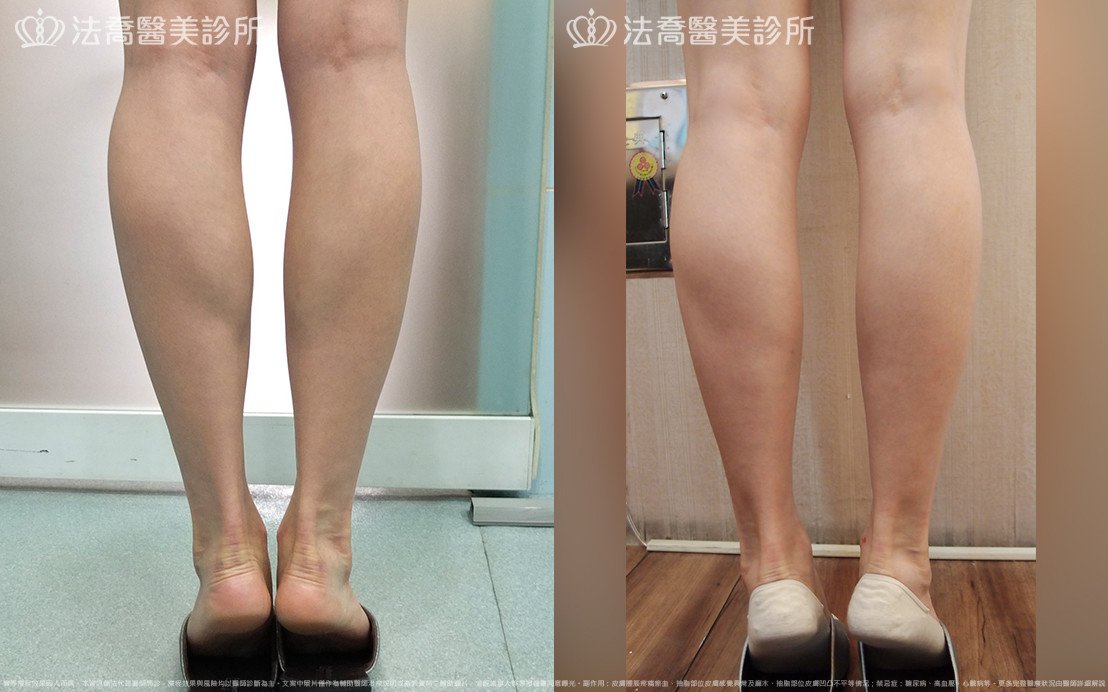 法喬醫美診所,邱浚彥,小腿神經截斷術