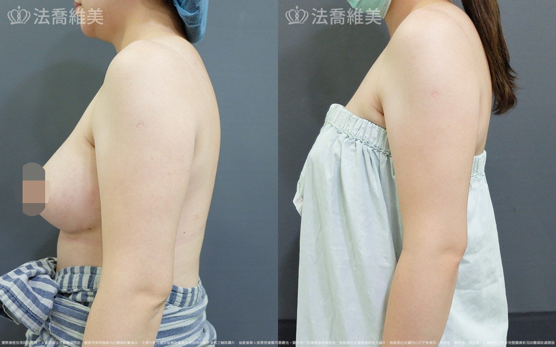 法喬醫美診所,邱浚彥,威塑蝴蝶袖