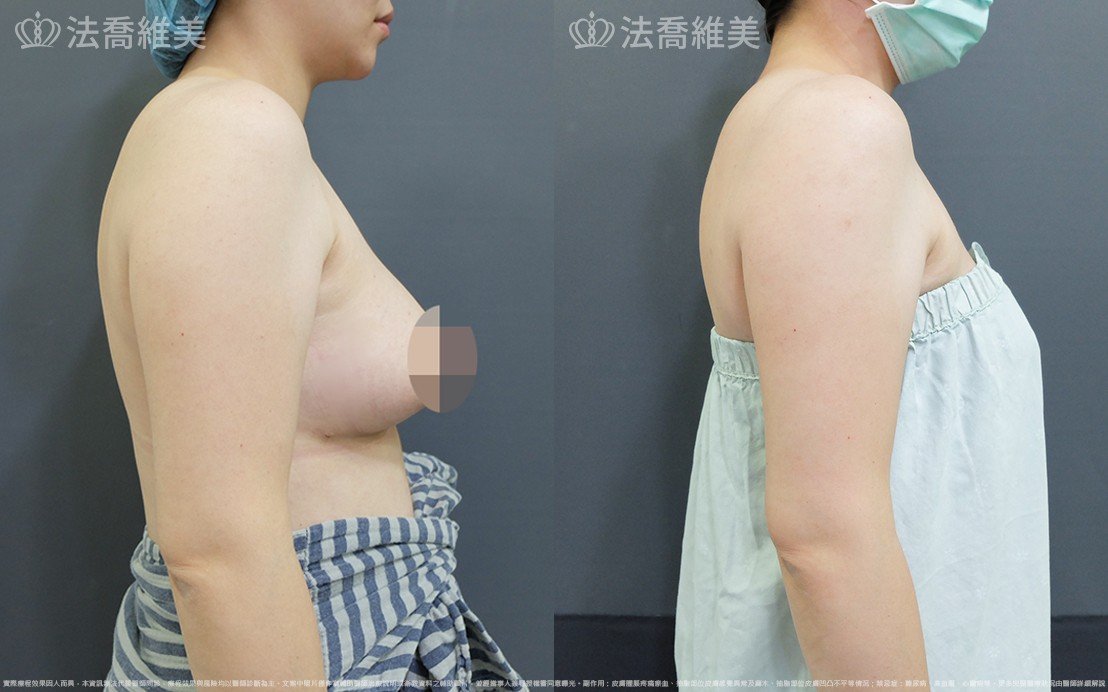 法喬醫美診所,邱浚彥,威塑蝴蝶袖