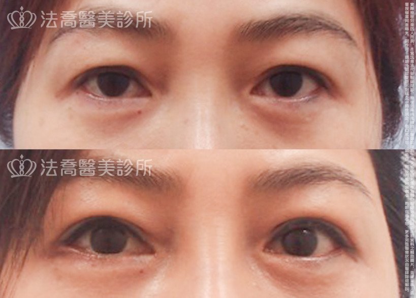 法喬醫美診所,邱浚彥,割雙眼皮,開眼頭,開眼尾