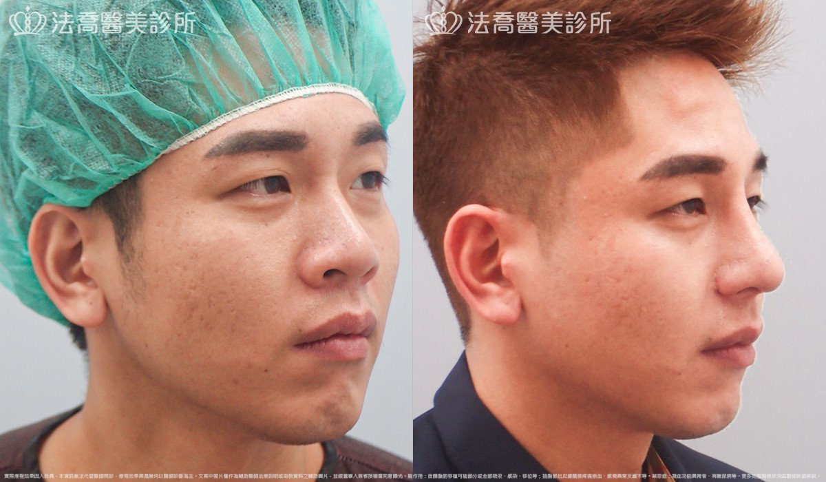 法喬醫美診所,邱浚彥,自體肋骨隆鼻