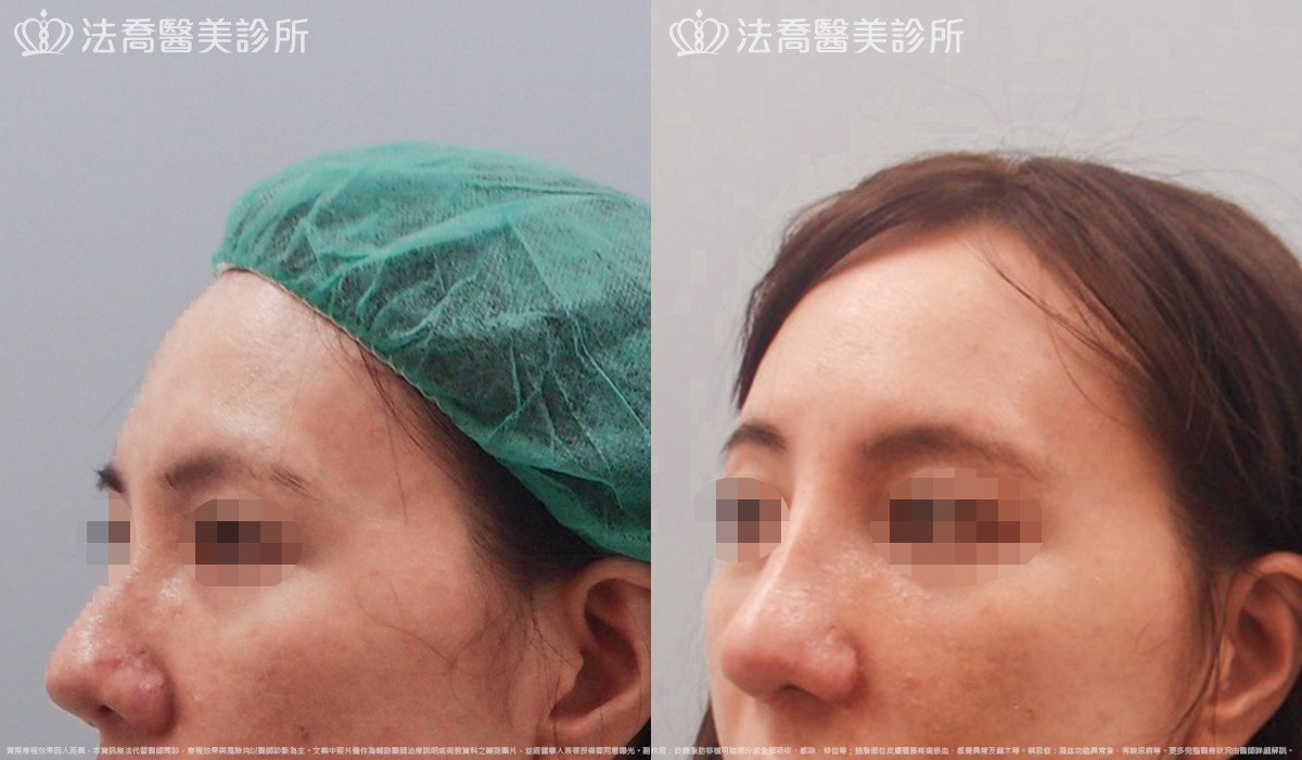 法喬醫美診所,邱浚彥,自體肋骨隆鼻