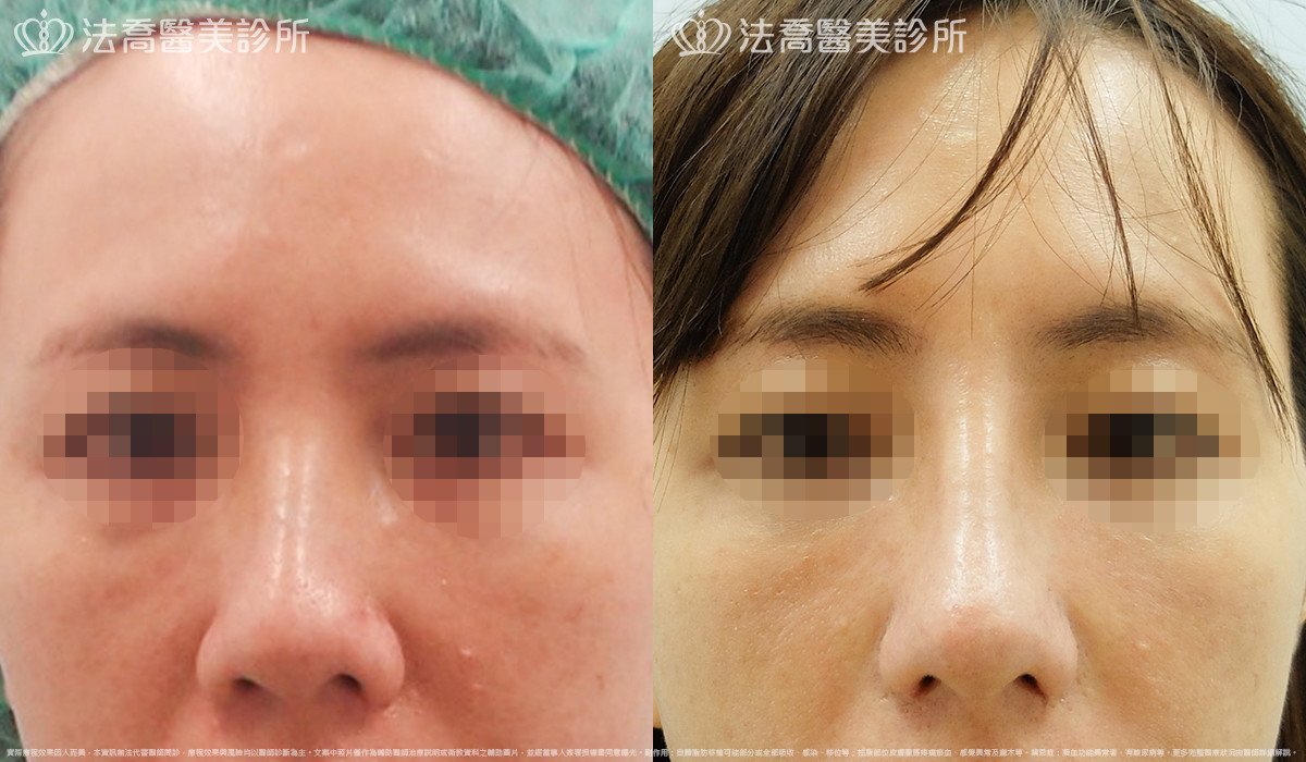 法喬醫美診所,邱浚彥,自體肋骨隆鼻