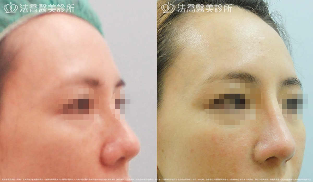 法喬醫美診所,邱浚彥,自體肋骨隆鼻