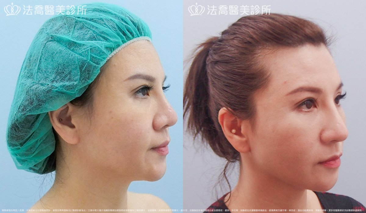 法喬醫美診所,邱浚彥,自體肋骨隆鼻