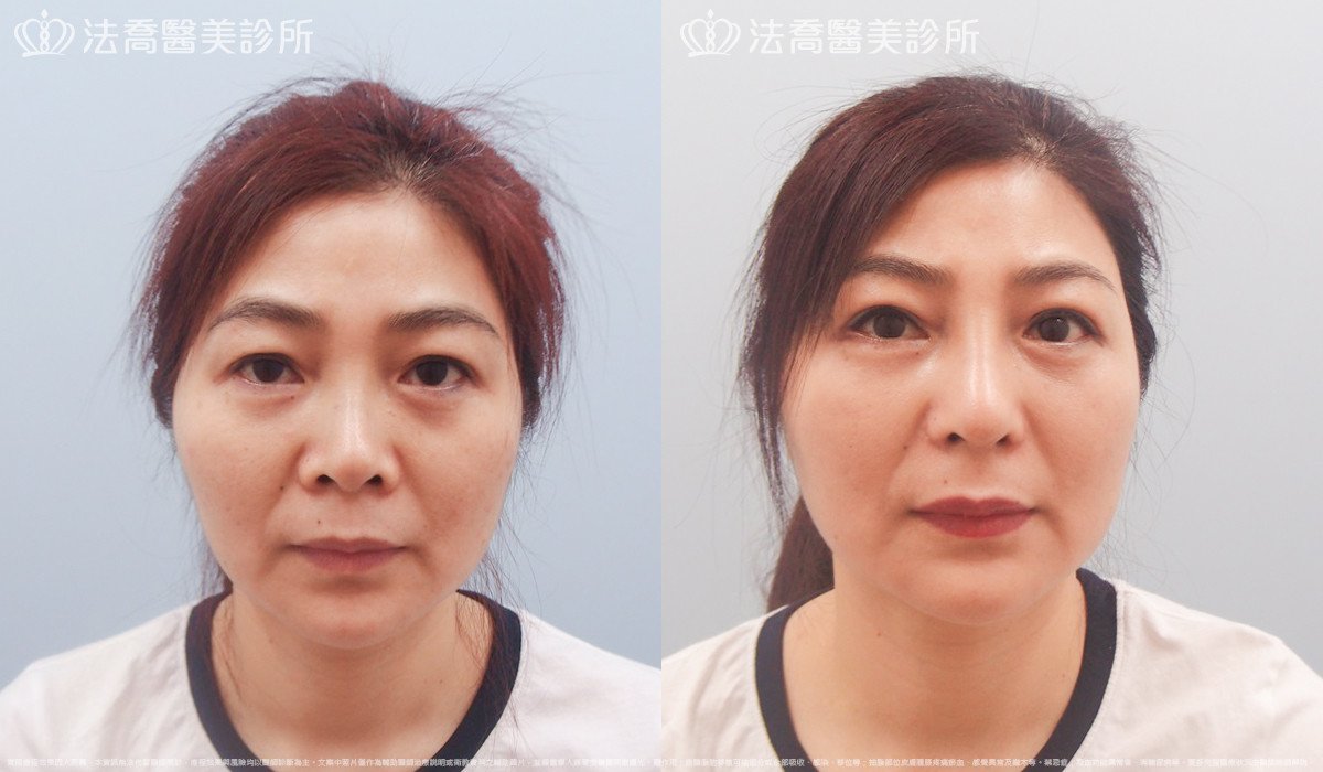 法喬醫美診所,邱浚彥,自體肋骨隆鼻