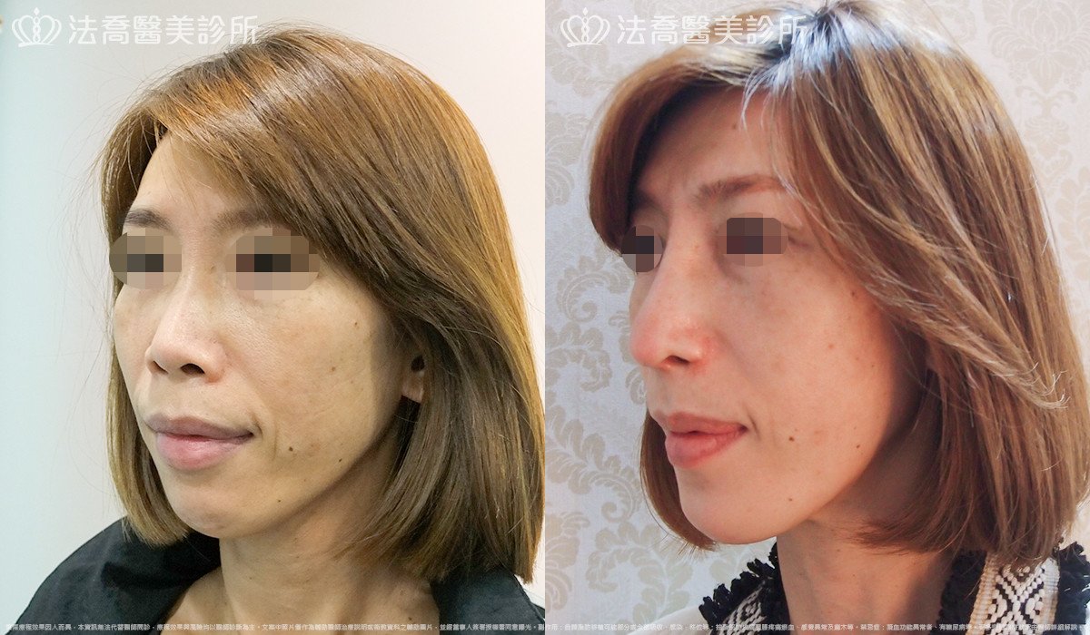 法喬醫美診所,邱浚彥,人工骨墊下巴