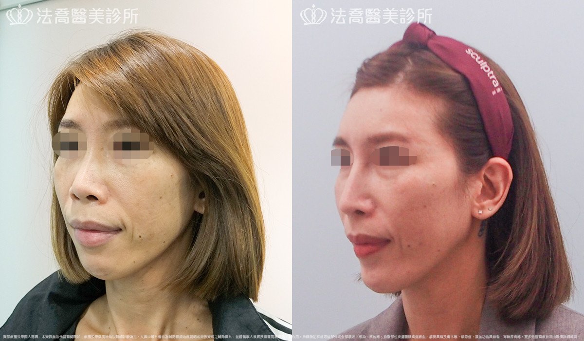 法喬醫美診所,邱浚彥,人工骨墊下巴