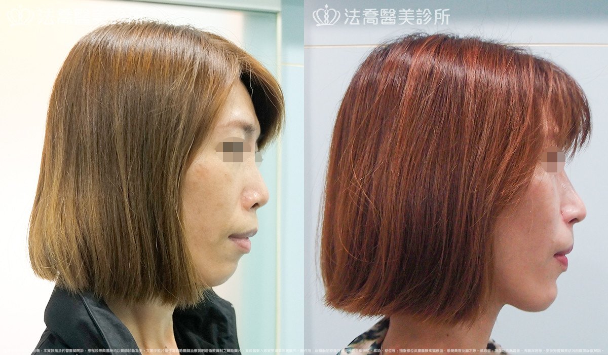 法喬醫美診所,邱浚彥,人工骨墊下巴