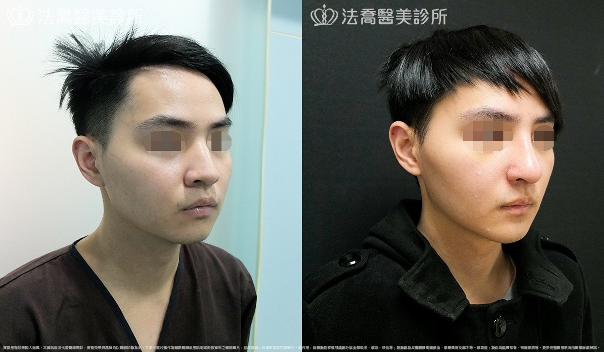 法喬醫美診所,邱浚彥,自體肋骨隆鼻