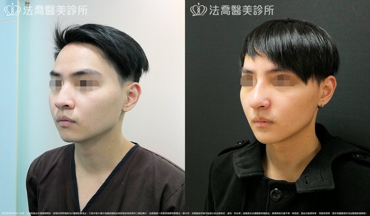 法喬醫美診所,邱浚彥,自體肋骨隆鼻