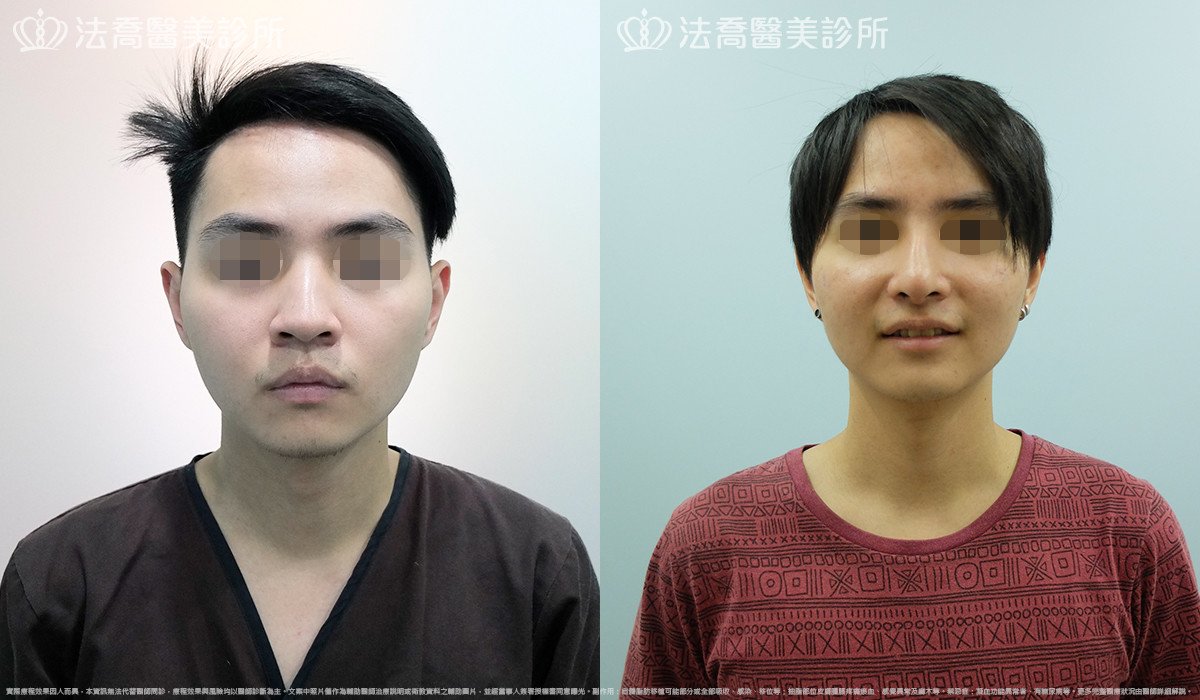 法喬醫美診所,邱浚彥,自體肋骨隆鼻