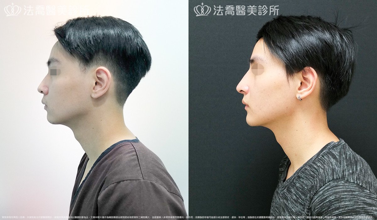 法喬醫美診所,邱浚彥,自體肋骨隆鼻