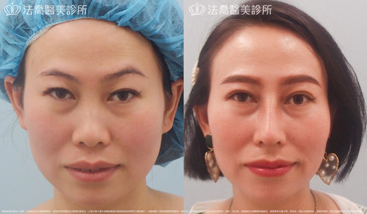 法喬醫美診所,邱浚彥,自體肋骨隆鼻