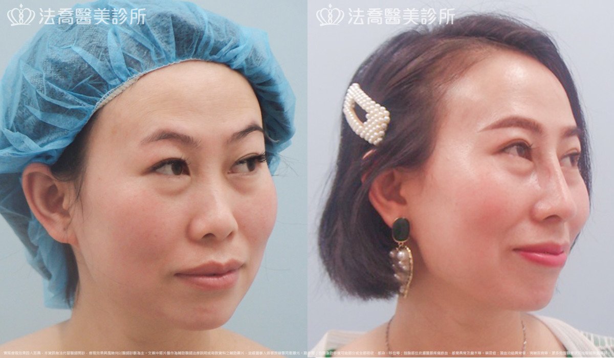 法喬醫美診所,邱浚彥,自體肋骨隆鼻