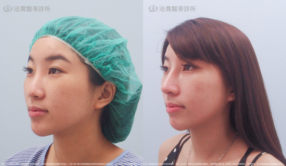 自體肋骨隆鼻,法喬醫美診所,邱浚彥