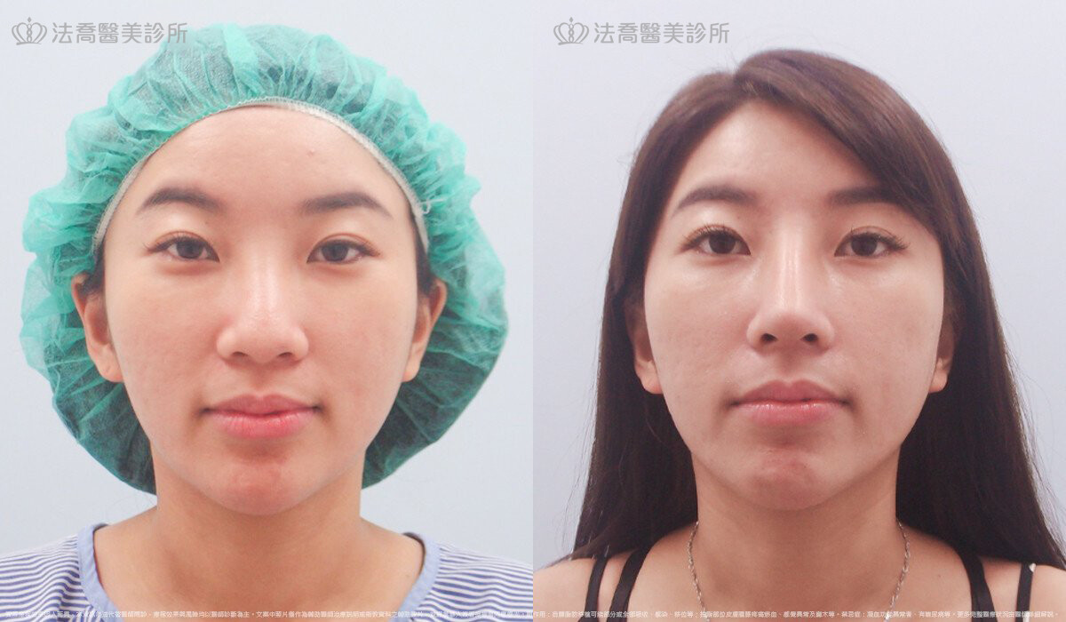 自體肋骨隆鼻,法喬醫美診所,邱浚彥