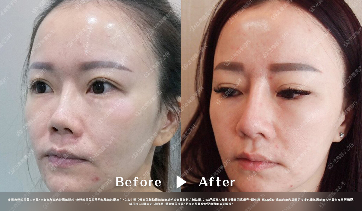 法喬醫美診所,邱浚彥,自體肋骨隆鼻