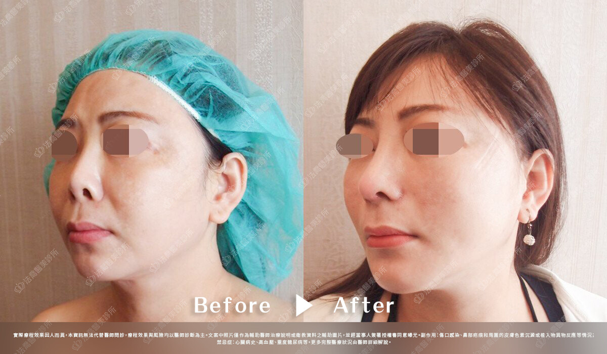 法喬醫美診所,邱浚彥,自體肋骨隆鼻