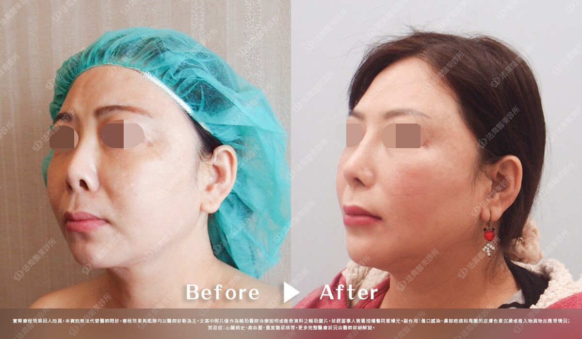 法喬醫美診所,邱浚彥,自體肋骨隆鼻