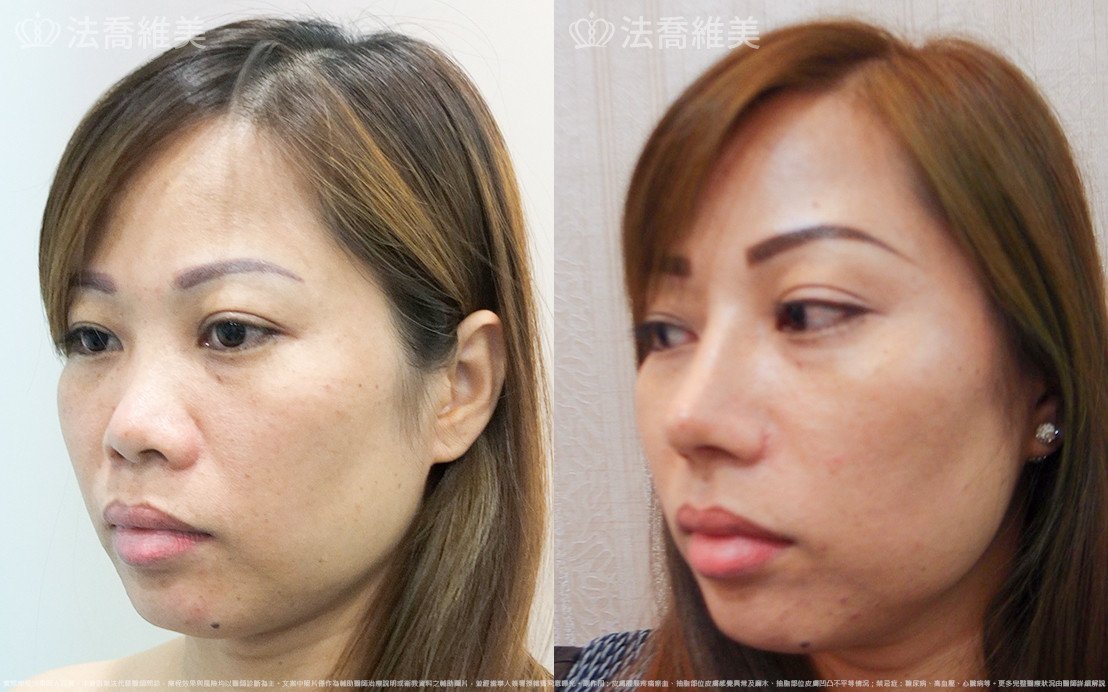 法喬醫美診所,邱浚彥,自體肋骨隆鼻
