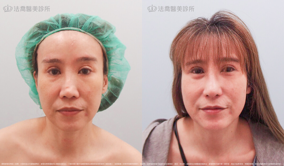 自體肋骨隆鼻,法喬醫美診所,邱浚彥