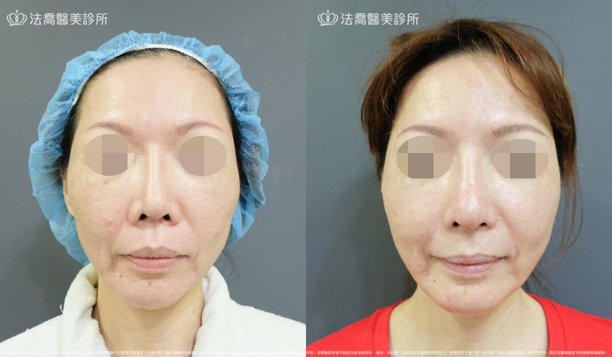 自體肋骨隆鼻,法喬醫美診所,邱浚彥