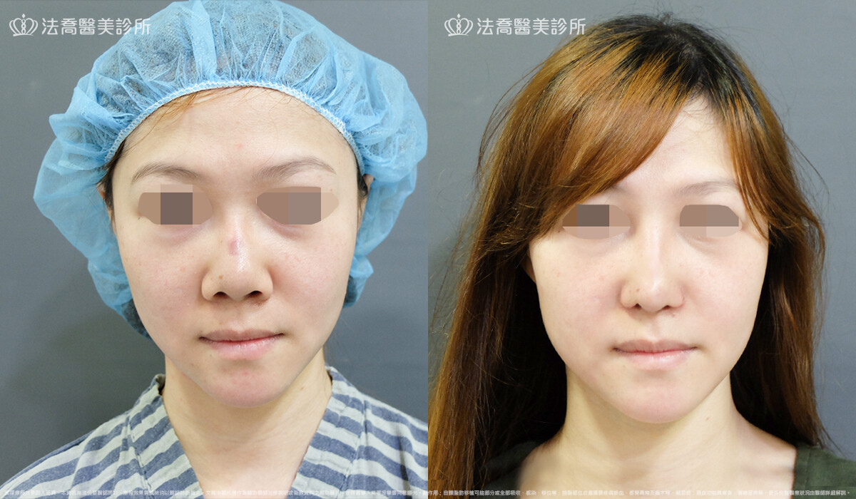 自體肋骨隆鼻,法喬醫美診所,邱浚彥