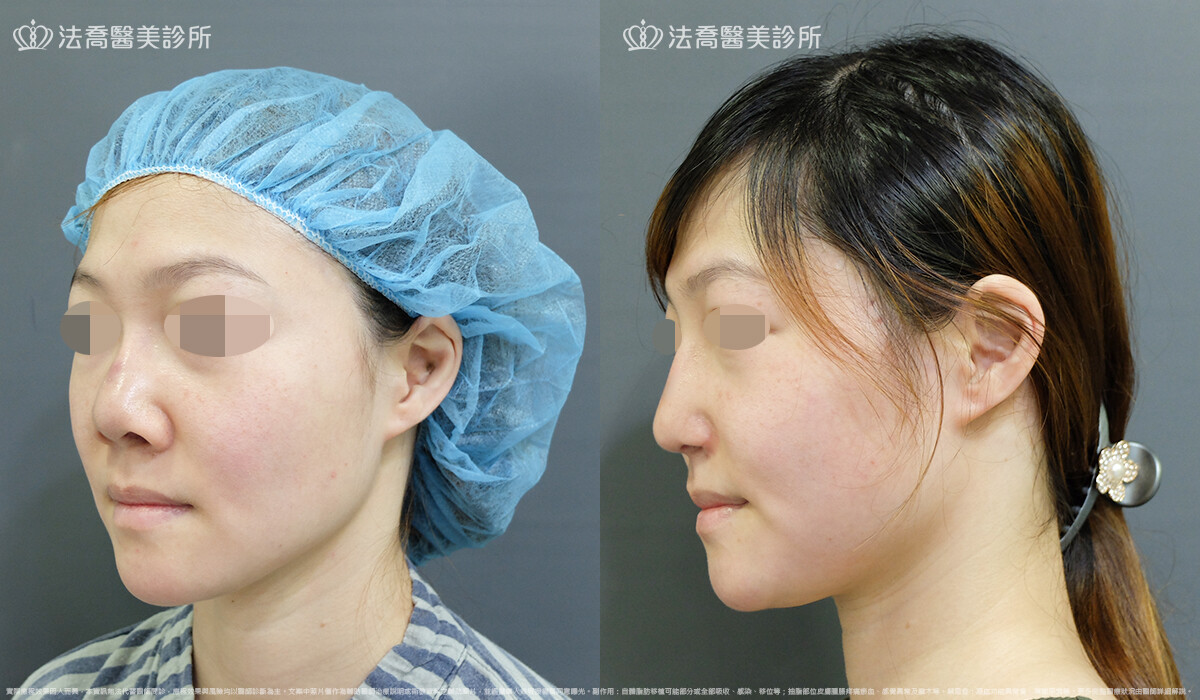自體肋骨隆鼻,法喬醫美診所,邱浚彥