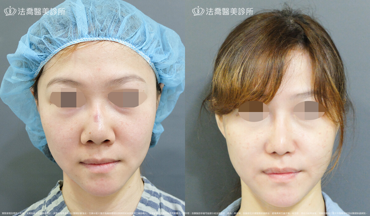 自體肋骨隆鼻,法喬醫美診所,邱浚彥