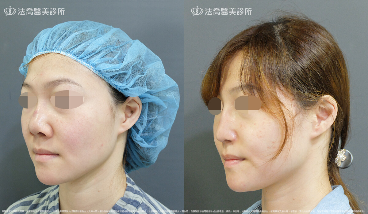 自體肋骨隆鼻,法喬醫美診所,邱浚彥