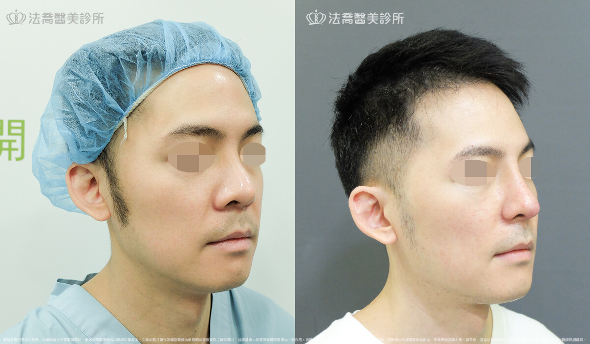 法喬醫美診所,邱浚彥,自體肋骨隆鼻