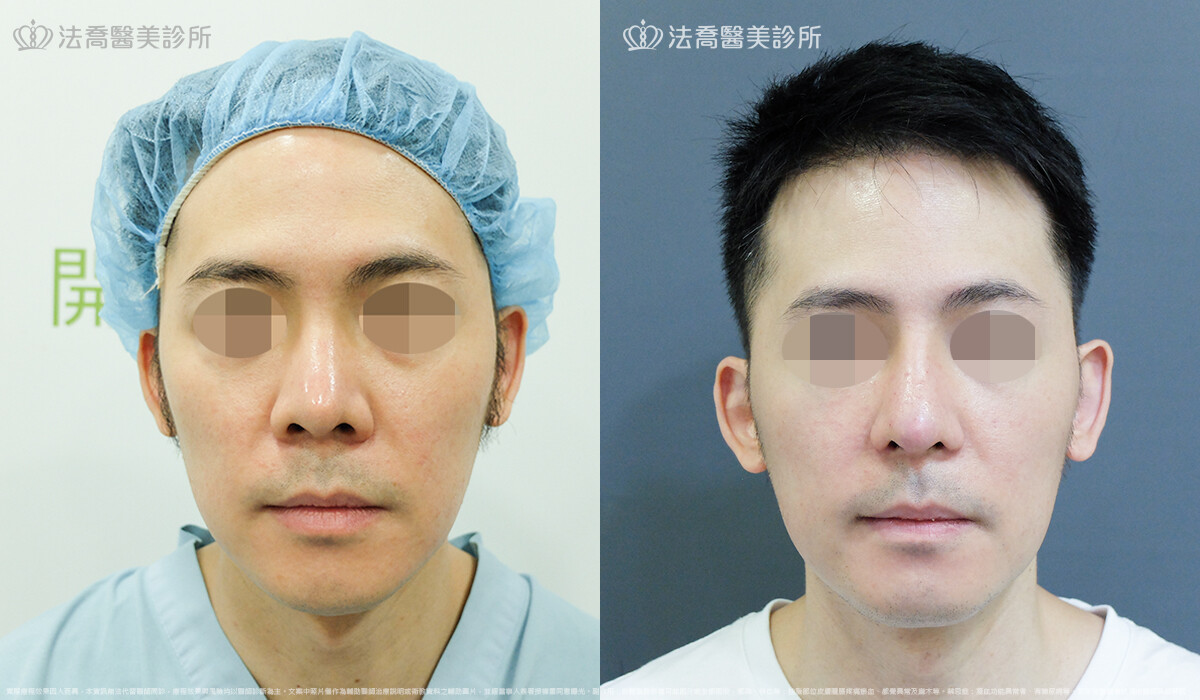 法喬醫美診所,邱浚彥,自體肋骨隆鼻