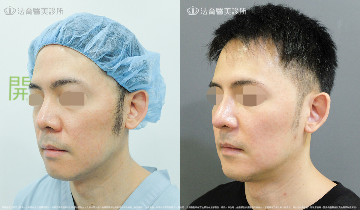 法喬醫美診所,邱浚彥,自體肋骨隆鼻