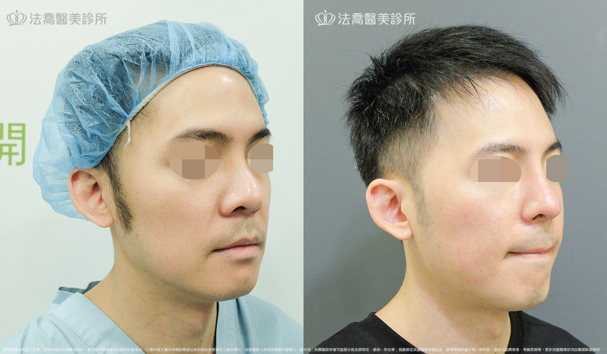 法喬醫美診所,邱浚彥,自體肋骨隆鼻