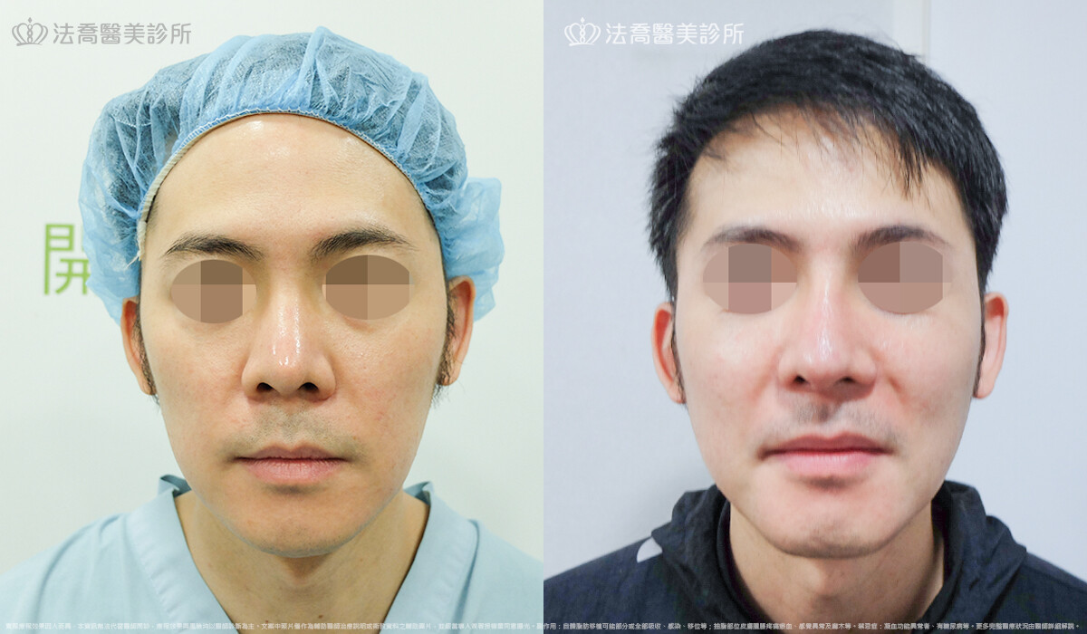 法喬醫美診所,邱浚彥,自體肋骨隆鼻